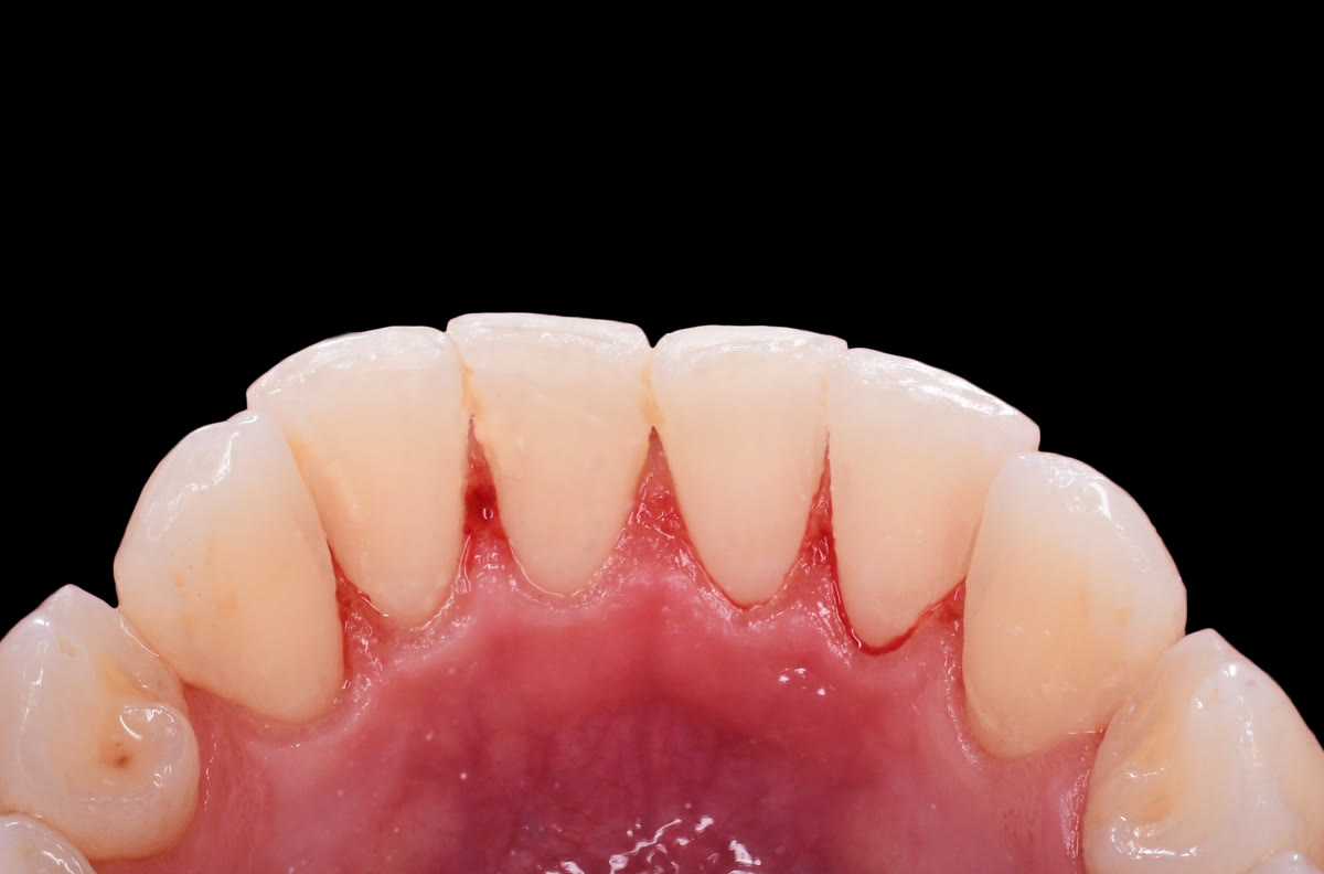 Teeth after ultrasonic cleaning and Air Flow polishing
