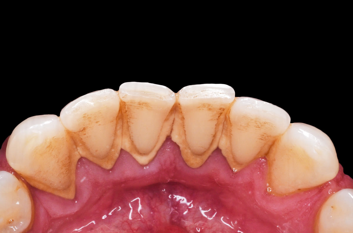 Teeth with tartar before cleaning