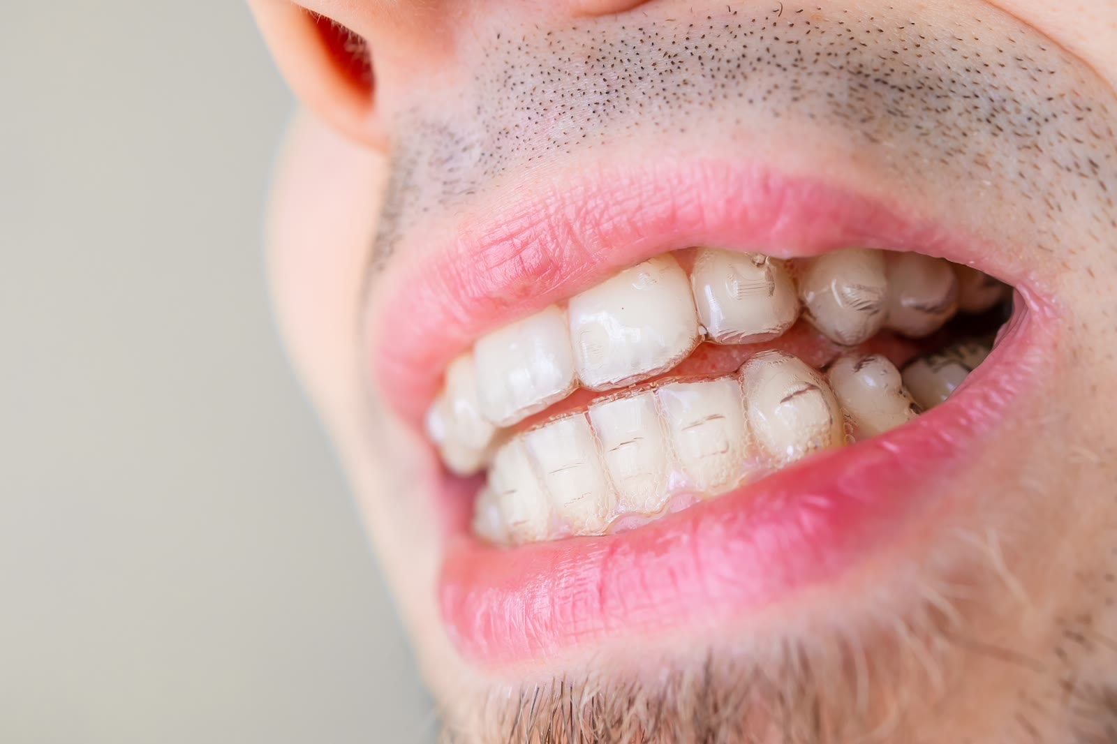 Poravnati zubi sa providnom folijom posle One Smile terapije