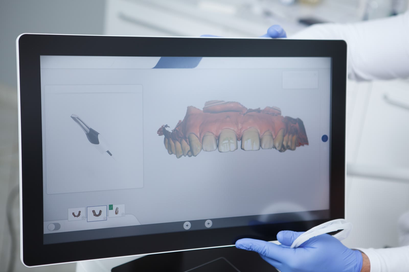 3D dental model in CAD software on a monitor