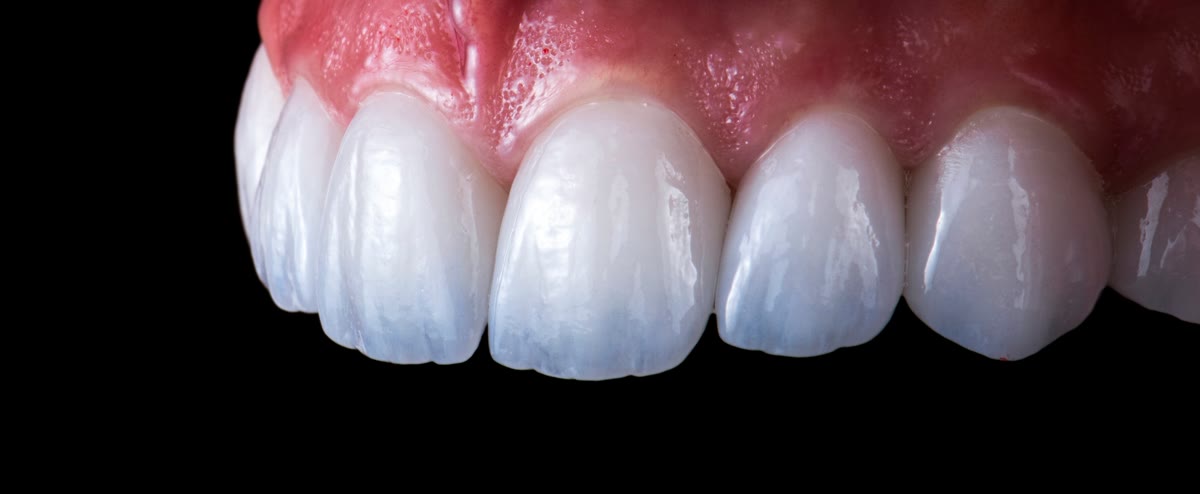 New metal-free crowns