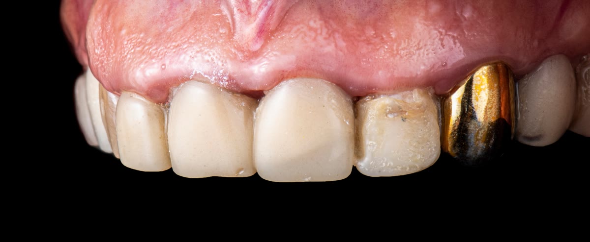 Old crowns before replacement