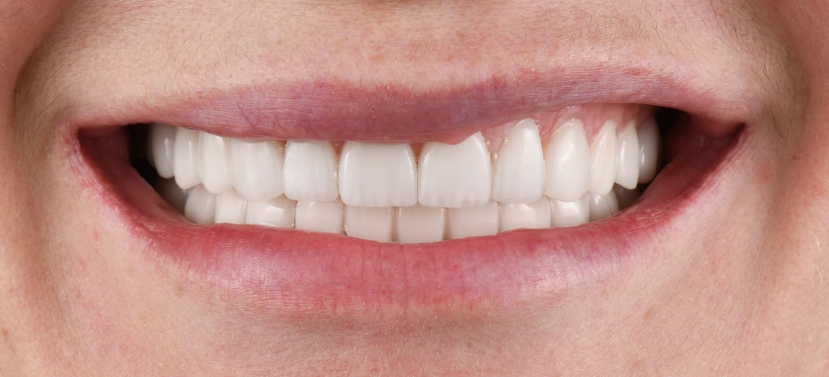Smile after aesthetic reconstruction