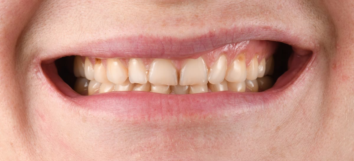 Smile before aesthetic reconstruction