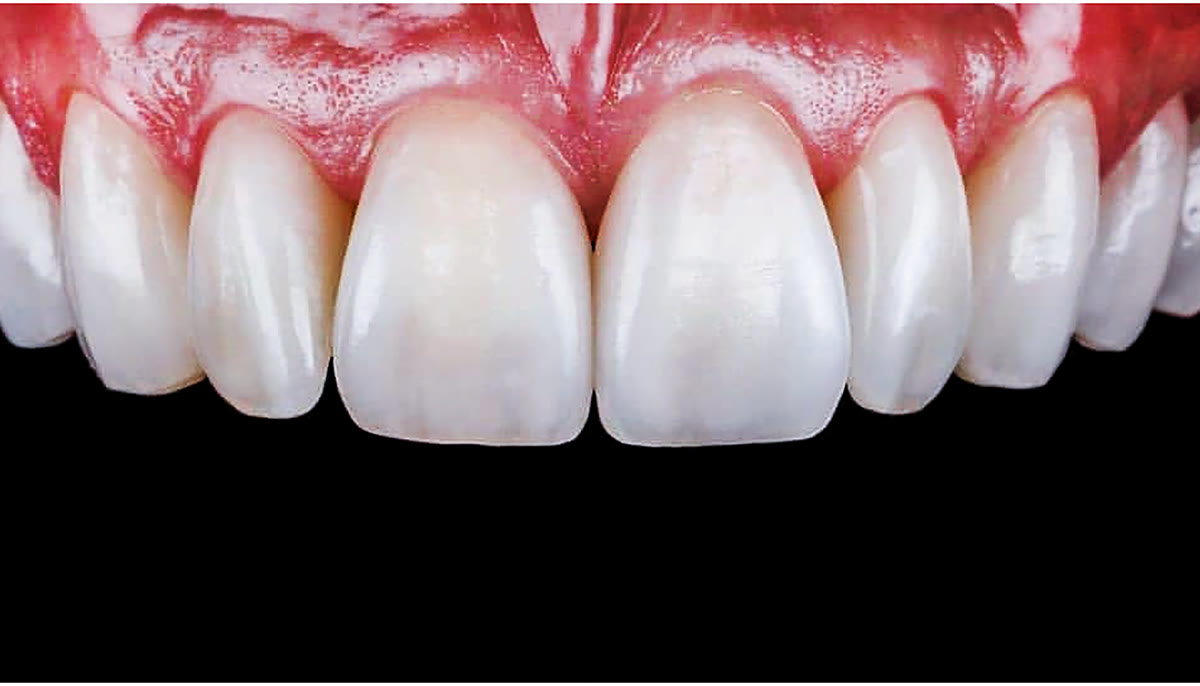 Front teeth after veneers