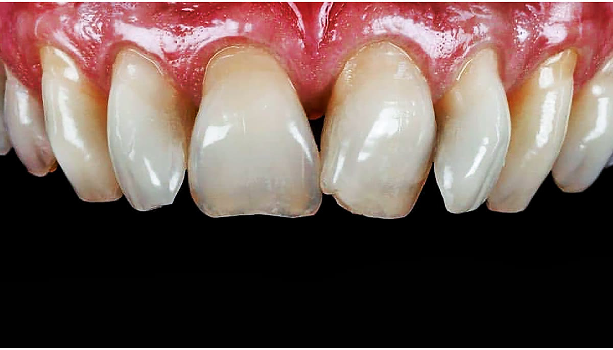 Worn front teeth before veneers
