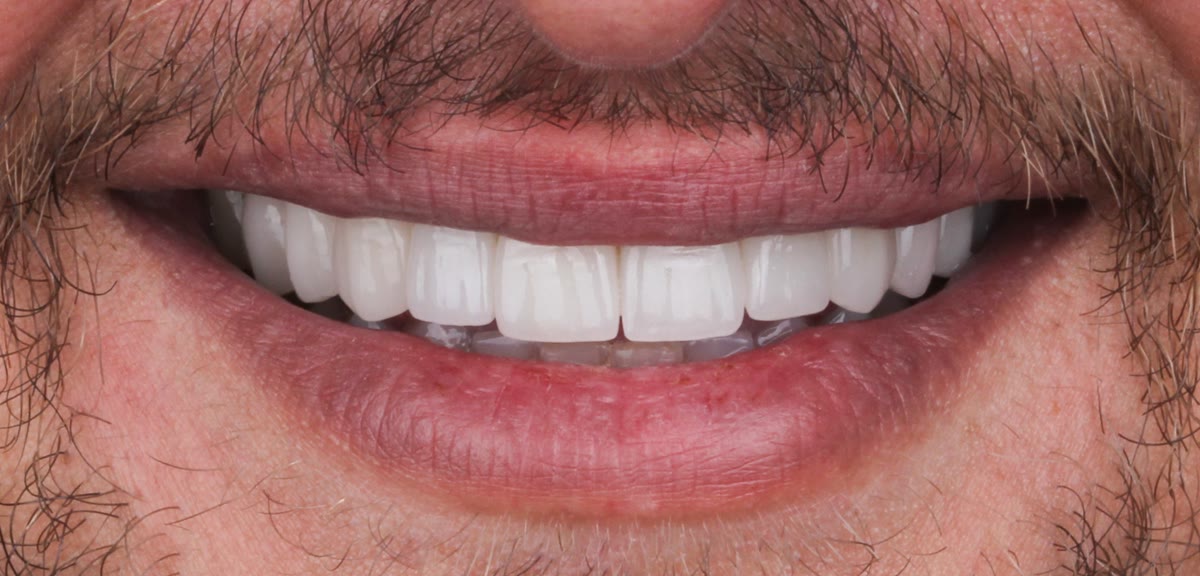 Front teeth after veneers