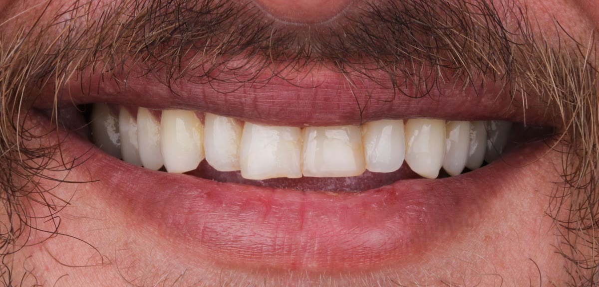 Front teeth before veneers