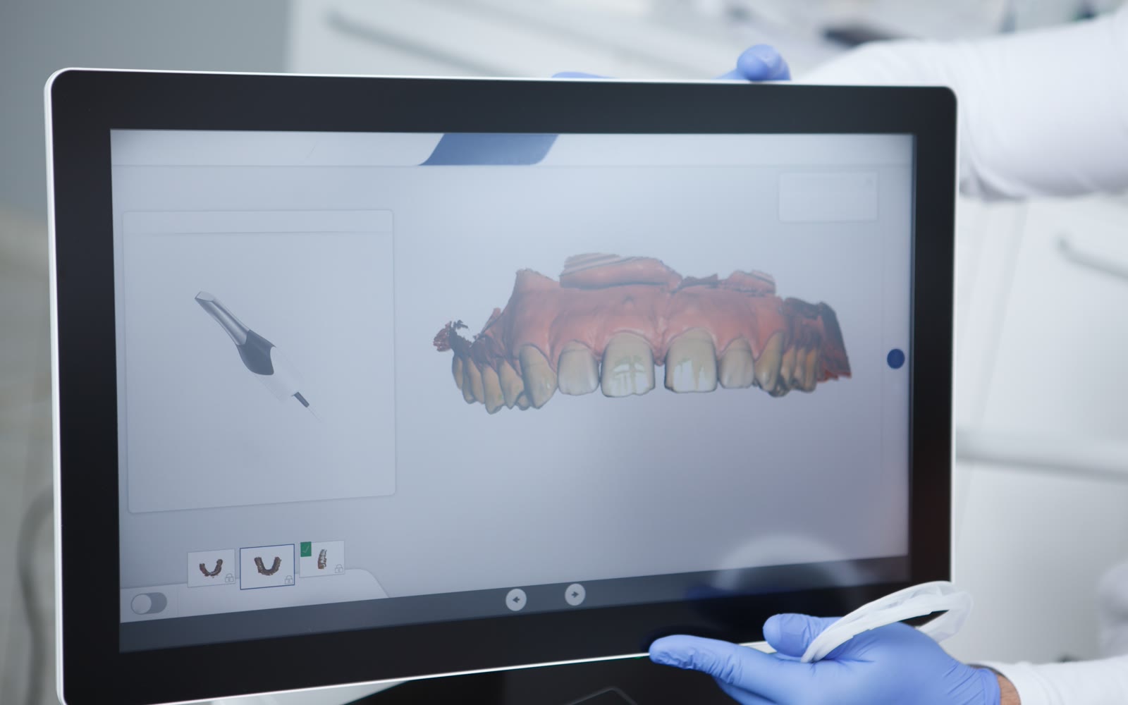 Intraoralni 3D sken zuba na ekranu skenera