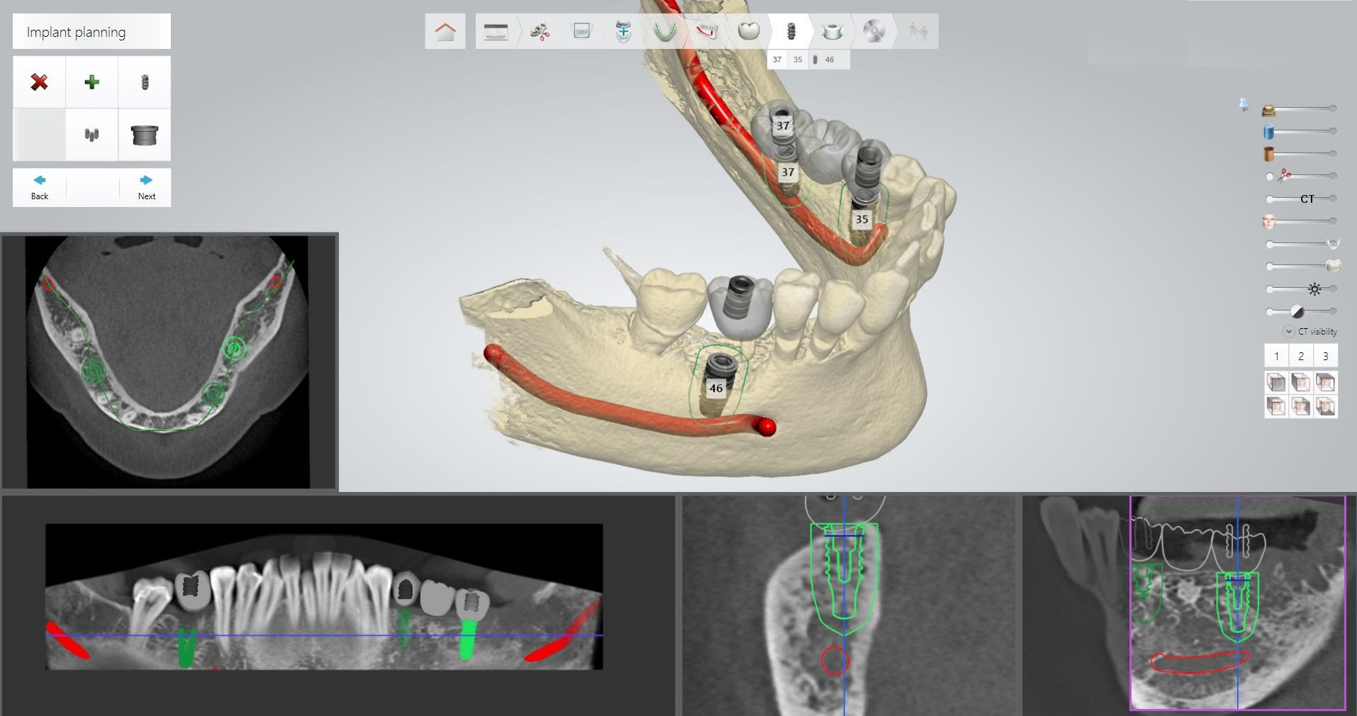 Softver za planiranje ugradnje implanata — 3D model vilice sa CBCT presecima